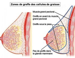 liposilling mammaire